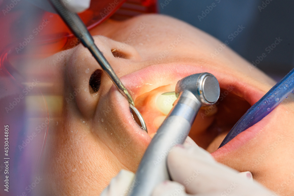 polishing teeth from the dental braces in process of removing dental braces from a Caucasian