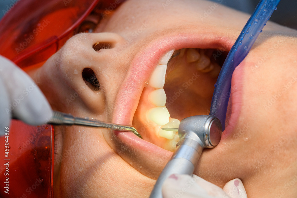 Fototapeta premium polishing teeth from the dental braces in process of removing dental braces from a Caucasian girl in a dental clinic with a female dentist