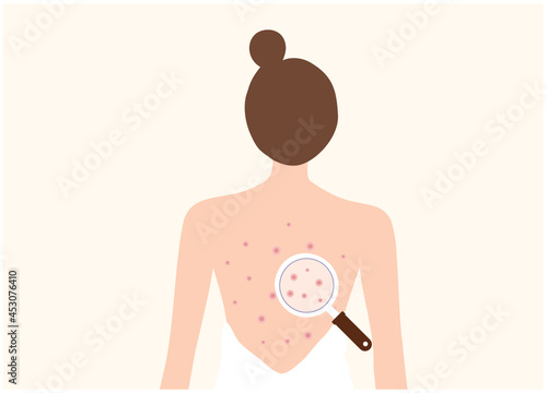 Acne on woman back. Allergy and Acne Skin Problems, Scratching her back vector illustration