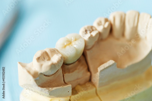 Image of denture close up