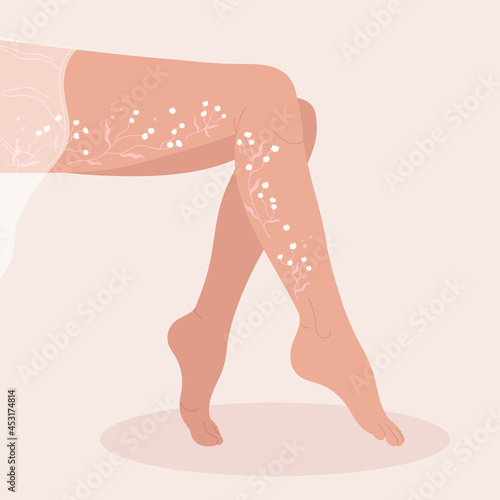 Varicosity legs. Vein thrombosis and varicose treatment in the form of flowers concept. Podiatry and healthcare. Flat cartoon vector illustration isolated on white background 