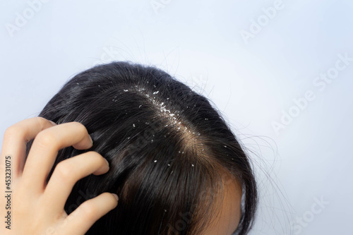 Dandruff problem. A girl with itchy head. Dandruff on the hair. Hair disease seborrhea. Fatty Dandruff. photo
