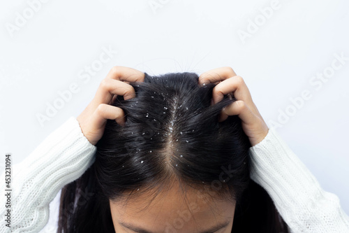 Dandruff problem. A girl with itchy head. Dandruff on the hair. Hair disease seborrhea. Fatty Dandruff. photo