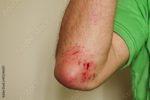 Φωτογραφία Fresh bleeding wound caused by falling on a hard rocks in a mountain