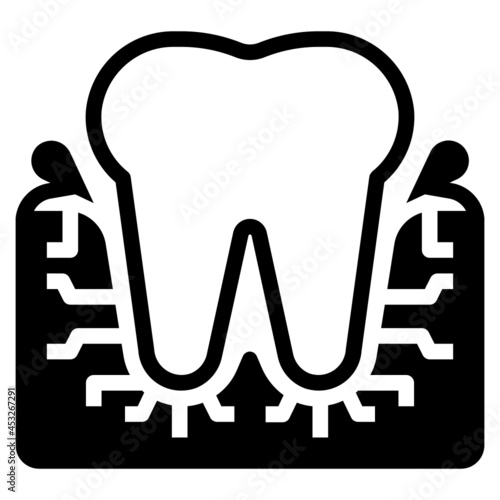 gingivitis 