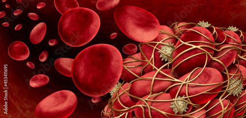 Photos Blood Clot Inside Artery