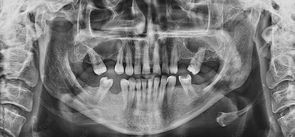 Panoramic dental X-ray close up. Case of Adentia. Panoramic dental X-ray close up. Case of Adentia.