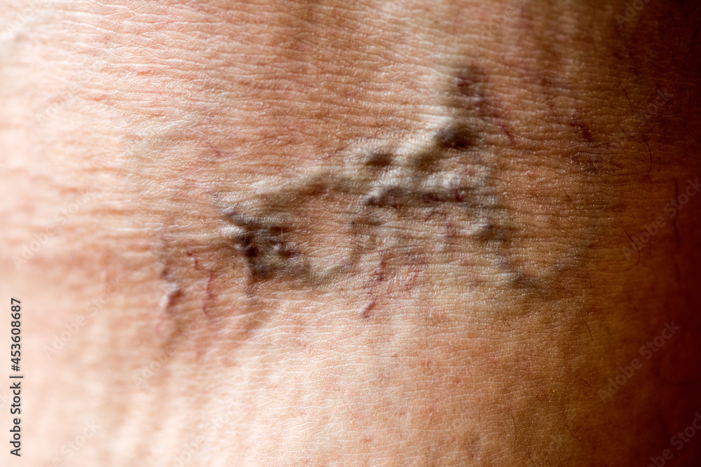Fototapeta premium Varicose veins in the skin of the leg.