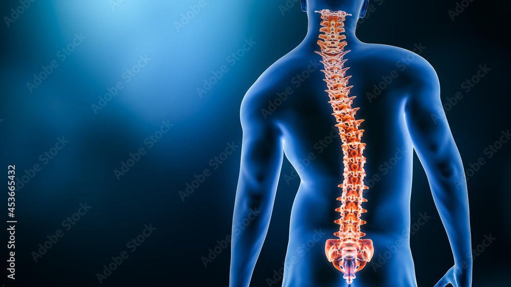 Curvature of the spine and man body back view 3D rendering illustration with copy space. Spine disorder or deformity, scoliosis, backbone injury, human anatomy and medical concepts. - obrazy, fototapety, plakaty 