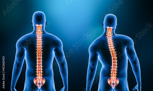 Comparison between normal backbone and scoliosis curvature of the spine with male model from back view 3D rendering illustration. Human anatomy, spinal deformity, backbone pathology, medical concepts. photo