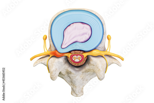 Superior view of human lumbar vertebra with herniated disc and spinal cord isolated on white background with copy space 3D rendering illustration. Anatomy, medical, backbone pathology concepts. photo