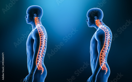 Comparison between normal curvature of the spine and kyphosis with male model from lateral view 3D rendering illustration. Human anatomy, spinal deformity, backbone pathology, medical concepts.