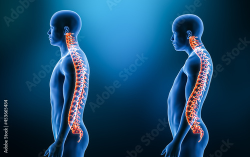 Comparison between normal backbone and lordosis curvature of the spine with man model from lateral view 3D rendering illustration. Human anatomy, spinal disorder, backbone pathology, medical concepts. photo