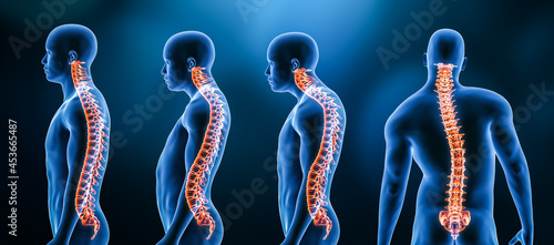 Three main curvatures of the spine disorders or deformities on male body: lordosis, kyphosis and scoliosis 3D rendering illustration. Human anatomy, back injury or disease, medical concepts. photo