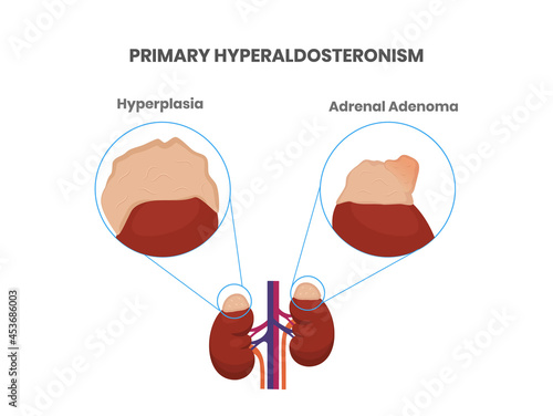 Primary aldosteronism causes: adrenal tumor and hyperplasia