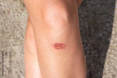 Beautiful female legs with a broken bleeding knee. First aid for falls, injury
