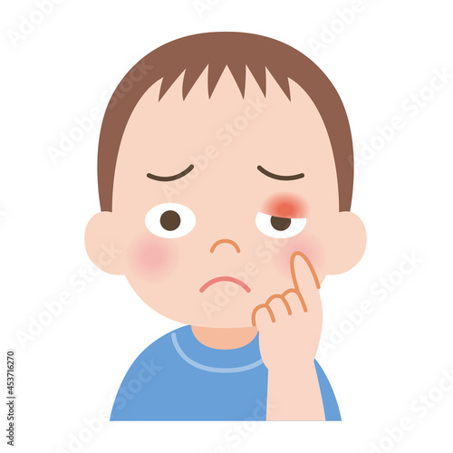 まぶたが腫れた男の子