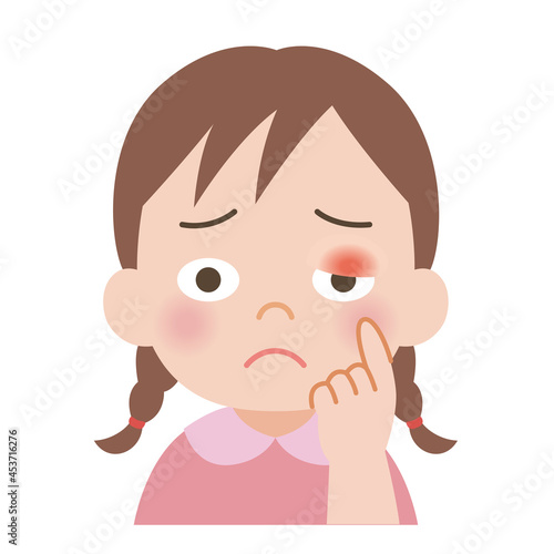 まぶたが腫れた女の子