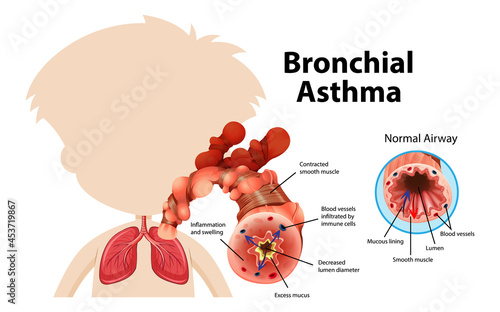 Bronchial Asthma diagram with normal airway and asthmatic airway
