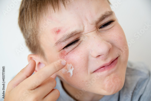 Close-up of the boy's face with a sadina. The child treats the wound on the face.