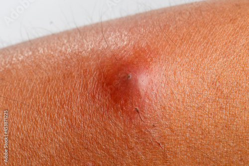 The patient had an abscess on his arm that was scratched by a cat.