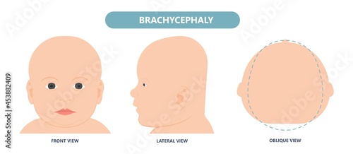 craniosynostosis helmet pillow flat head autism brain skull bone deformity baby infant child newborn defect birth anterior Metopic Born genes genetic position sleep shape deformation tummy time 
