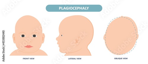 craniosynostosis helmet pillow flat head autism brain skull bone deformity baby infant child newborn defect birth anterior Metopic Born genes genetic position sleep shape deformation tummy time 