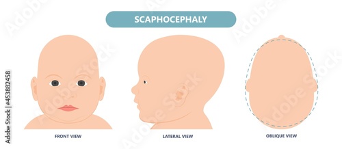 craniosynostosis helmet pillow flat head autism brain skull bone deformity baby infant child newborn defect birth anterior Metopic Born genes genetic position sleep shape deformation tummy time 