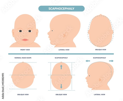 craniosynostosis helmet pillow flat head autism brain skull bone deformity baby infant child newborn defect birth anterior Metopic Born genes genetic position sleep shape deformation tummy time 