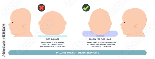 craniosynostosis helmet pillow flat head autism brain skull bone deformity baby infant child newborn defect birth anterior Metopic Born genes genetic position sleep shape deformation tummy time 