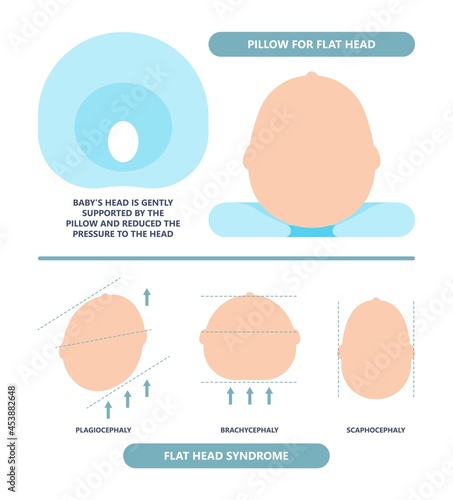 craniosynostosis helmet pillow flat head autism brain skull bone deformity baby infant child newborn defect birth anterior Metopic Born genes genetic position sleep shape deformation tummy time 