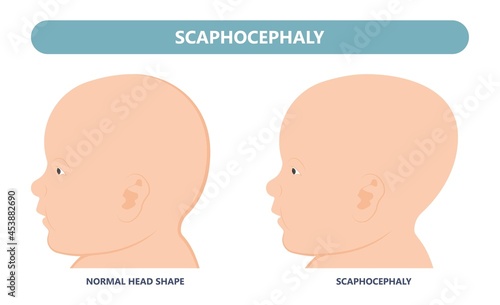 craniosynostosis helmet pillow flat head autism brain skull bone deformity baby infant child newborn defect birth anterior Metopic Born genes genetic position sleep shape deformation tummy time 