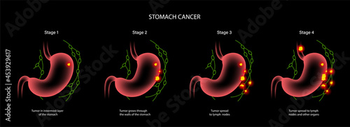 Stomach cancer anatomy