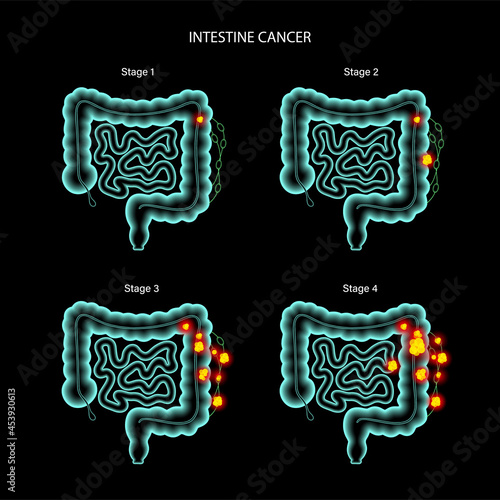 Intestine 3D cancer