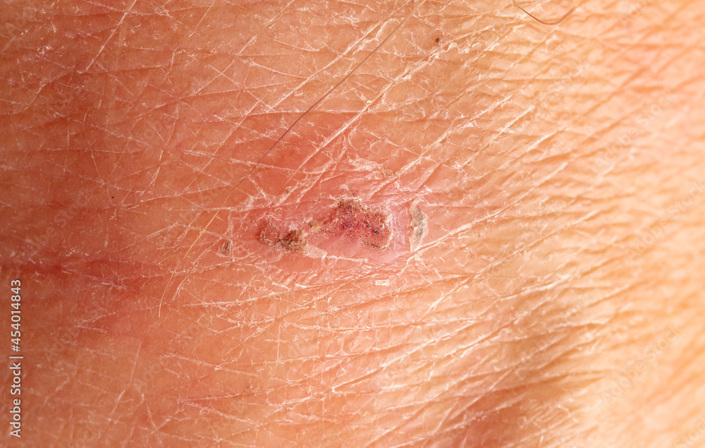 Fototapeta premium A wound on the skin of a person.