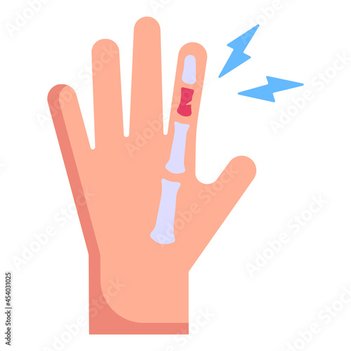 Hand Fracture

