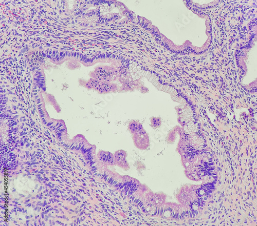 Camera photo of adenocarcinoma in situ (AIS) of cervix, magnification 200x, photograph through a microscope