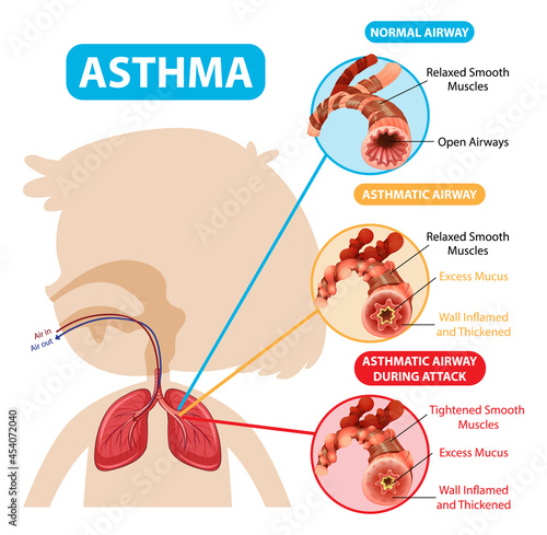 Asthma diagram with normal airway and asthmatic airway