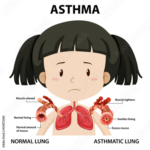 Asthma diagram with normal lung and asthmatic lung