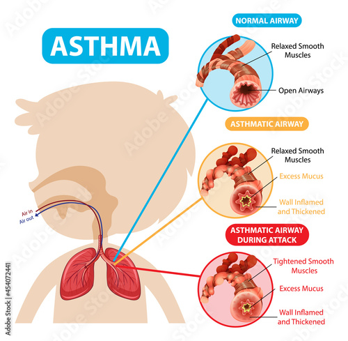 Asthma diagram with normal airway and asthmatic airway