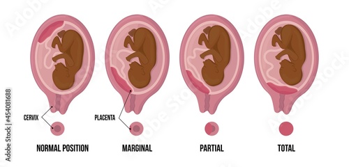 Different Placental Locations During African afroamerican Pregnancy. Normal, marginal, partial and total previa. black and brown skin.