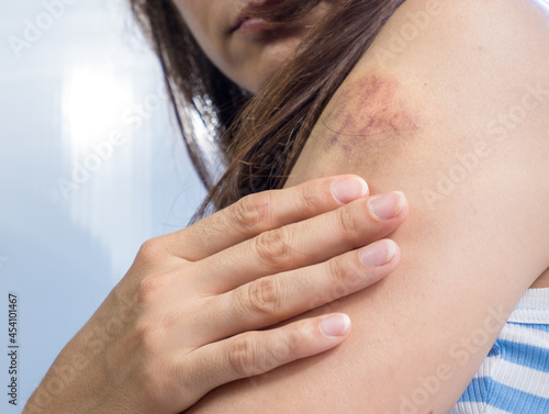 Obraz na płótnie A woman in a white-blue T-shirt with a bruise on her arm after the beatings touches the injury with her hand while sitting at the window close-up w salonie
