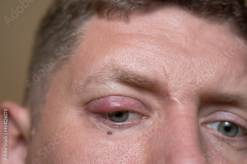  the guy has an eye disease, inflammation of the eyelid