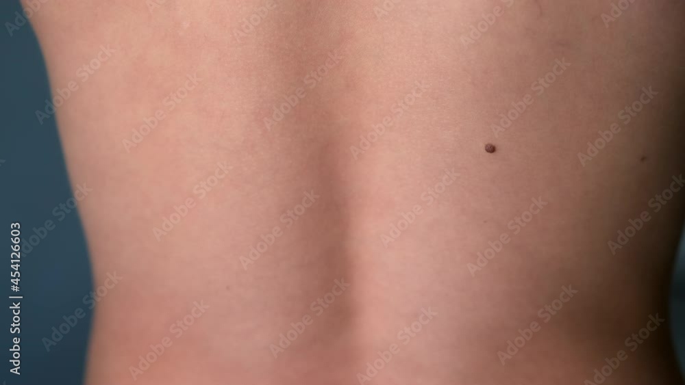 Boy's white skin in back with big brown mole before laser removing. Birthmark, melanoma and nevus on teen's skin. Boy's white skin in back with big brown mole before laser removing. Birthmark, melanoma and nevus on teen's skin.
