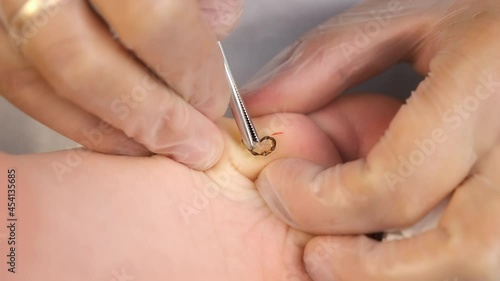 Surgeon is removing wart on teen boy's foot using surgical forceps in hospital, hands in gloves closeup. Remove papillomavirus verruca on leg. One day surgery concept. Sore and wound after operation. photo