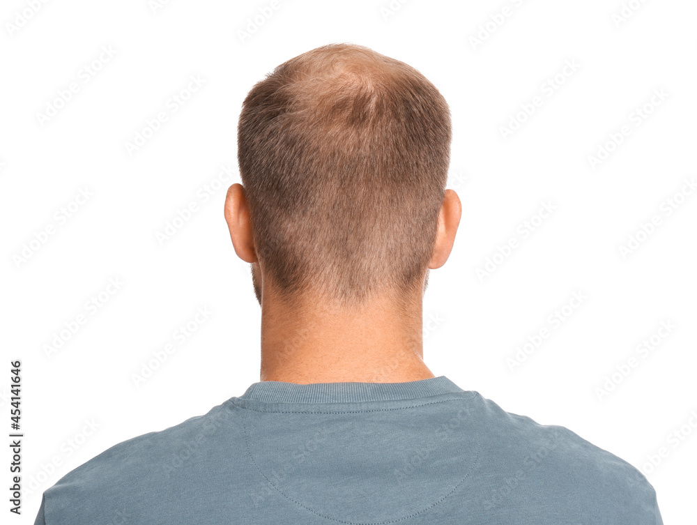 Fototapeta premium Man with hair loss problem on white background, back view. Trichology treatment