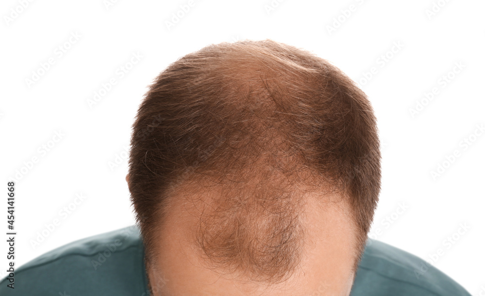 Obraz premium Man with hair loss problem on white background, closeup. Trichology treatment