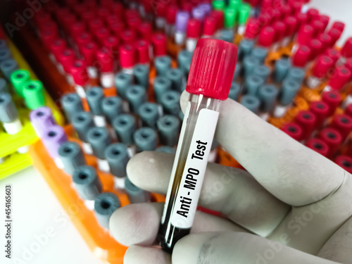 Blood sample for Proteinase 3 Ab test. cANCA,Anti MPO test,Anti PR3 test diagnosis of autoimmune disease test in the laboratory background. photo