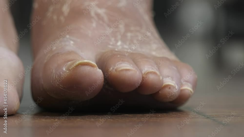 Movement of the feet up and down standing on the floor. Physical exercises after a broken leg, after removing the plaster bandage. Movement of the feet up and down standing on the floor. Physical exercises after a broken leg, after removing the plaster bandage.