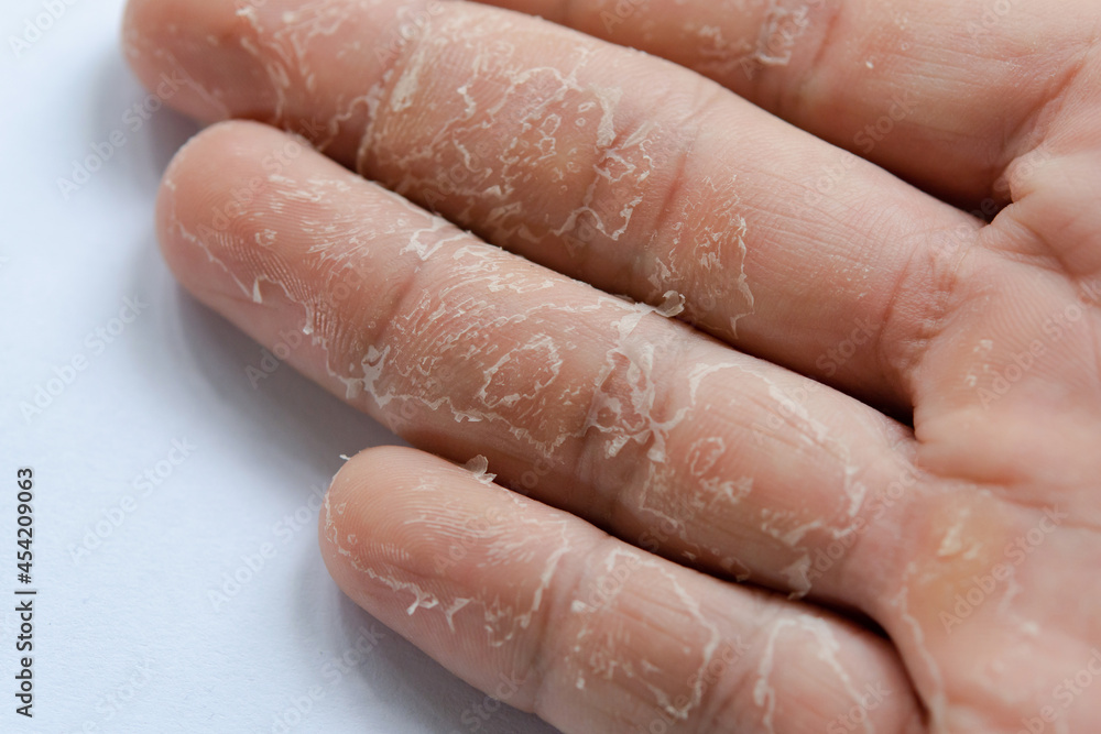 Fototapeta premium Peeling skin on hand and fingers. Desquamation